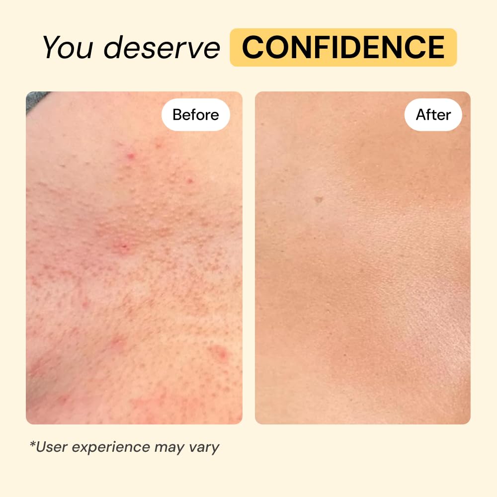 MyMagicHealer Universal Flare Care – Multi-Purpose Solution | Skin Flare-Ups - Hidradenitis Suppurativa, Folliculitis, Boils, Cysts | Anti-Chafing | Irritated Skin Relief w/Propolis & Egg Yolk 4 oz