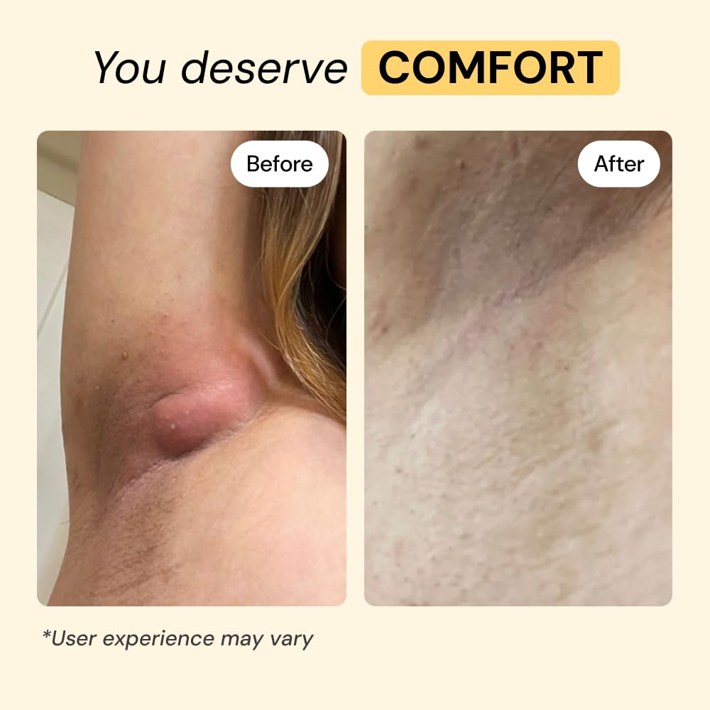 MyMagicHealer Universal Flare Care – Multi-Purpose Solution | Skin Flare-Ups - Hidradenitis Suppurativa, Folliculitis, Boils, Cysts | Anti-Chafing | Irritated Skin Relief w/Propolis & Egg Yolk 4 oz