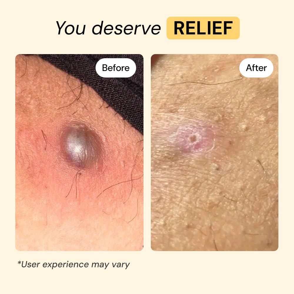 MyMagicHealer Universal Flare Care – Multi-Purpose Solution | Skin Flare-Ups - Hidradenitis Suppurativa, Folliculitis, Boils, Cysts | Anti-Chafing | Irritated Skin Relief w/Propolis & Egg Yolk 4 oz